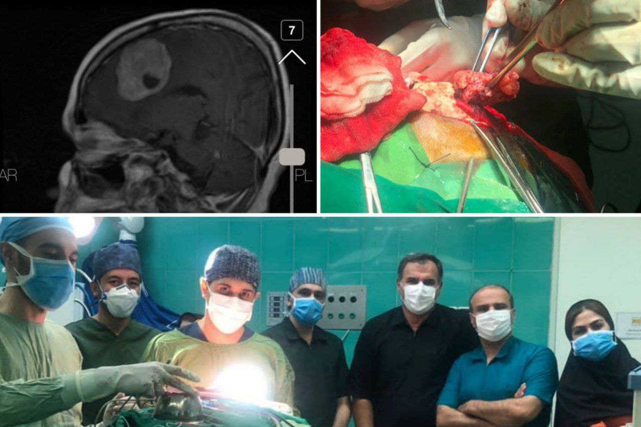 خروج تومور مغزی حجیم از سر بانوی ۷۰ ساله دامغانی+ عکس