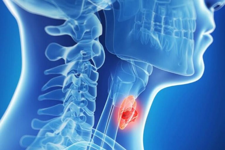 کم‌کاری تیروئید با یک آزمایش ساده خون و دارو درمانی کنترل می­‌شود