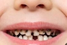 بیماری‌های دهان و دندان و عدم پوشش بیمه ها در این اصل مهم سلامتی!؟
