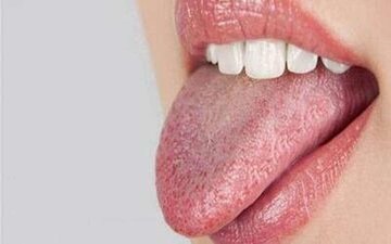 زبان سفید چه چیزی درباره سلامت میگوید؟