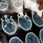 هشدار درباره شروع آلزایمر از ۴۰ سالگی/ عوامل مؤثر در پیشگیری از آلزایمر
