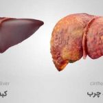 چگونه به کبد چرب مبتلا نشویم؟/ خوراکی‌های مفید و مضر برای کبد