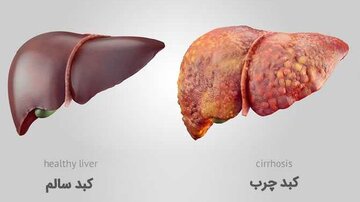 چگونه به کبد چرب مبتلا نشویم؟/ خوراکی‌های مفید و مضر برای کبد