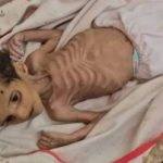 داستان تلخ پزشکان گرسنه در غزه/ کودکانی که تبدیل به اسکلت شده‌اند/عکس