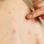 نقش آموزش عمومی و اعتمادسازی در موفقیت واکسیناسیون سرخک در کشور/ ایران، یکی از چهار کشور دارای گواهی حذف سرخک