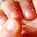 علت پوست‌پوست شدن اطراف ناخن و روش‌های درمان