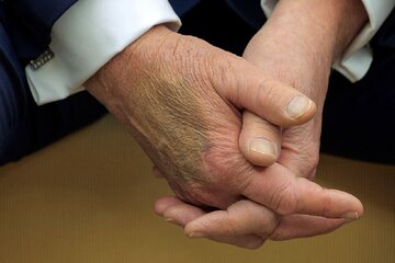 کبودی خبرساز روی دست ترامپ / آیا ترامپ سالم است؟ / کاخ سفید: کبودی ناشی از دست دادن زیاد است