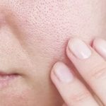 با منافذ باز پوست چه کنیم؟/ این منافذ به طور قطعی درمان می‌شوند؟