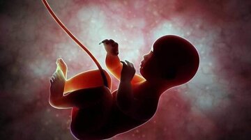 بیانیه وزارت بهداشت درباره سقط جنین مبتلا به سندروم داون