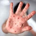 خروج این بیماری از وضعیت اضطراری اعلام شد