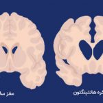 درمان موفقیت‌آمیز یک بیماری سخت برای اولین بار