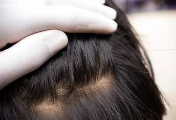 راهکار خلاصی کودک از شپش را بشناسید