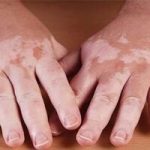 عامل تشدید بیماری پیسی/ روش‌های درمان