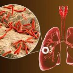ابتلای ۶ هزار ایرانی به یک بیماری خطرناک ریوی/ ۸ استان در صدر شیوع بیماری