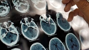 با مصرف این لبنیات از آلزایمر نجات پیدا کنید