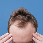 کدام ریزش مو در مردان شایعتر است؟